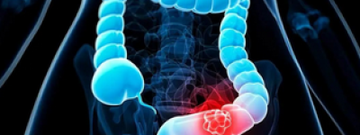 我妈直肠癌晚期居然好了：坚持靶向+化疗