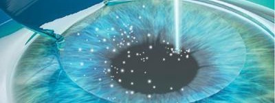 近视手术价格一览表2023，现如今半飞秒/全飞秒激光手术一般多少钱？