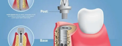 请问：种植牙多少钱一颗2023年？目前国内/种牙收费价目表(2023更新中）
