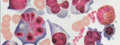 刚刚2025年！伊沙佐米医保价格出炉，伊沙佐米医保后患者还需支付多少费用