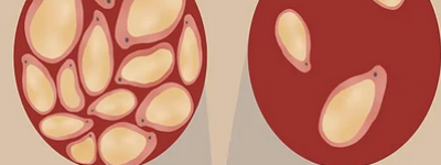 现如今：甘油三酯高吃什么才能降脂，食疗降甘油三酯的方法一览表